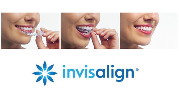 The banner of invisalign with three pictures of woman